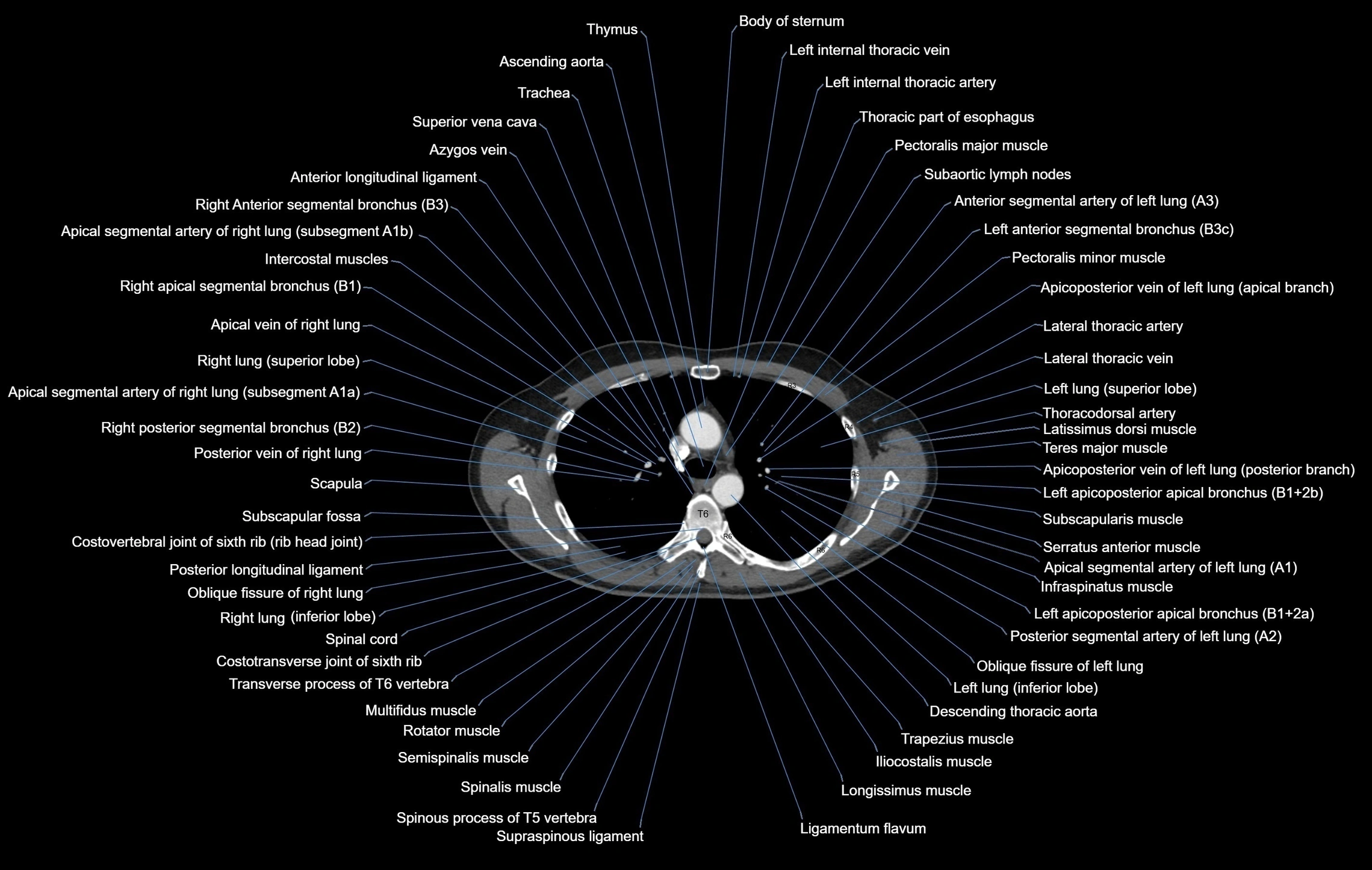 CT chest (thorax) soft tissue window labelled axial cross sectional anatomy radiology image-00044.webp